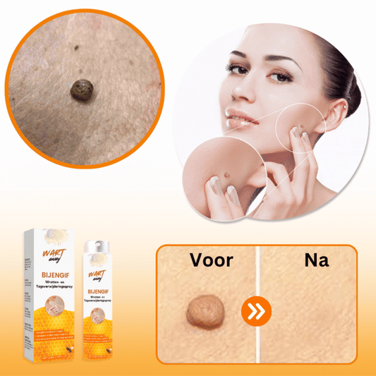 WartAway™ Wratten en tags verwijderingsspray | Verwijder alle wratten en huidoneffenheden binnen 7 dagen