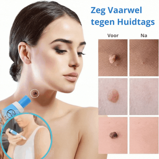 ZuiverHuid™ | Verwijder uw huidflapjes in 4 dagen zonder pijn of littekens!
