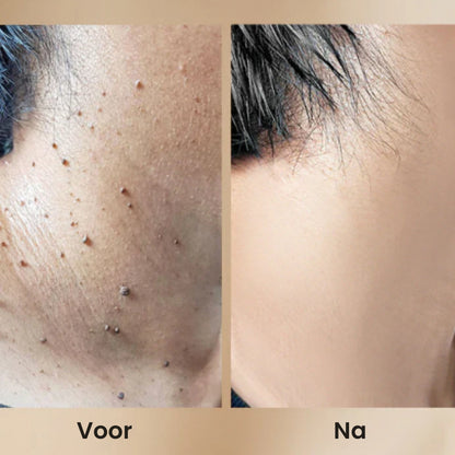 WartAway™ Wratten en tags verwijderingsspray | Verwijder alle wratten en huidoneffenheden binnen 7 dagen