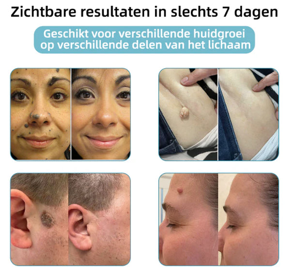 Xorita™ Niet-invasieve Laser pen voor Moedervlek - en Wratverwi jdering Promax