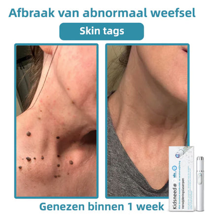 Xorita™ Niet-invasieve Laser pen voor Moedervlek - en Wratverwi jdering Promax