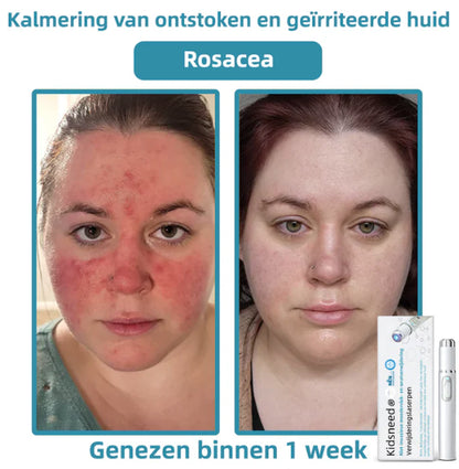 Xorita™ Niet-invasieve Laser pen voor Moedervlek - en Wratverwi jdering Promax