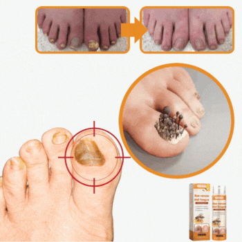 FungiClear™ Anti-Schimmel Spray | Weg met schimmelnagels in 5 dagen. Zonder dokters, zonder gedoe