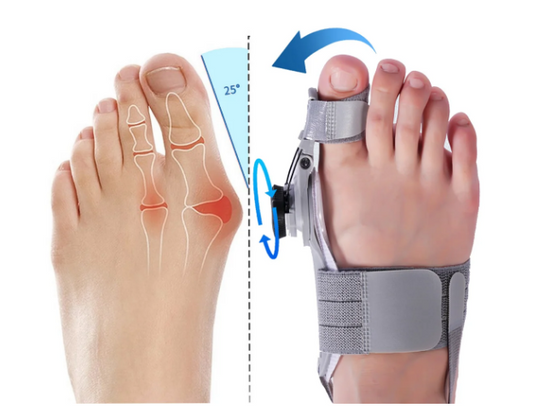 Glamova Bunion Fix